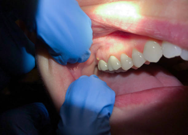 Best Emergency Root Canal Treatment in Mount Sterling, IL